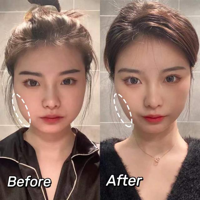 脂肪型发腮了还能变回去吗，20岁发腮了还能变回去吗