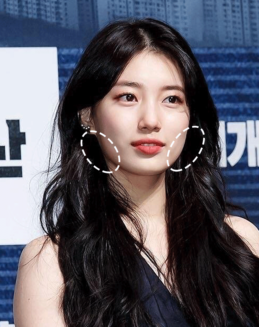 脂肪型发腮了还能变回去吗，20岁发腮了还能变回去吗