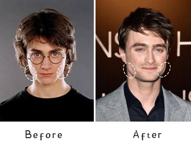 脂肪型发腮了还能变回去吗，20岁发腮了还能变回去吗