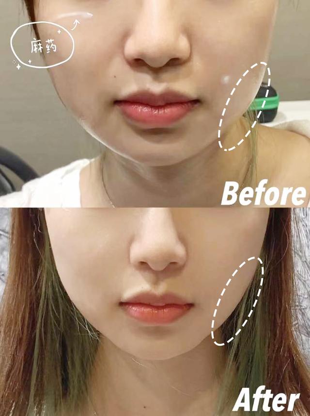 脂肪型发腮了还能变回去吗，20岁发腮了还能变回去吗