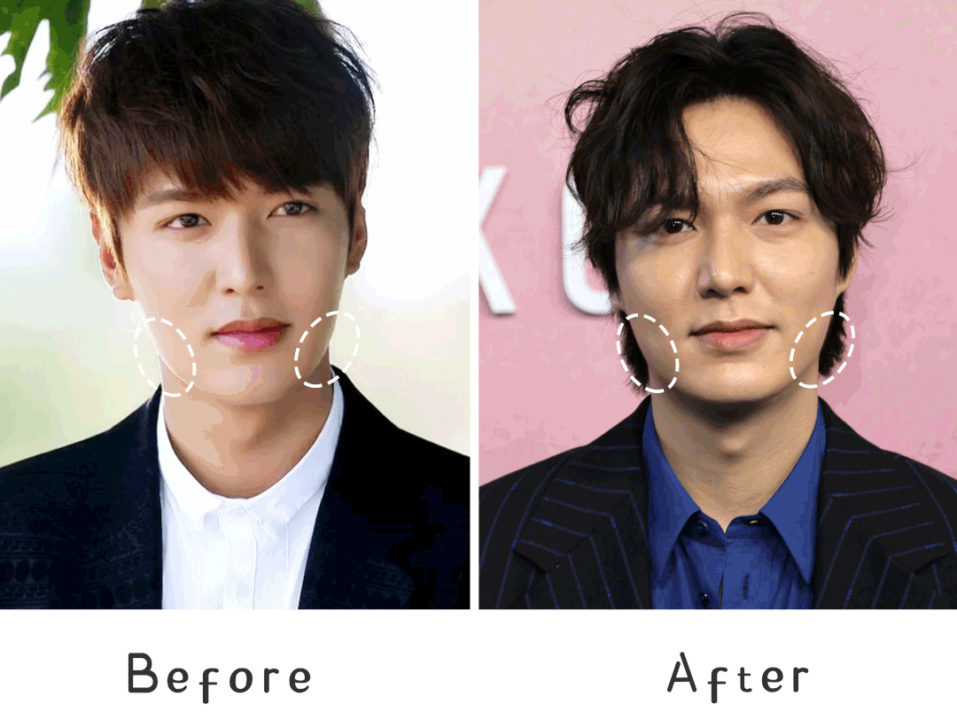 脂肪型发腮了还能变回去吗，20岁发腮了还能变回去吗