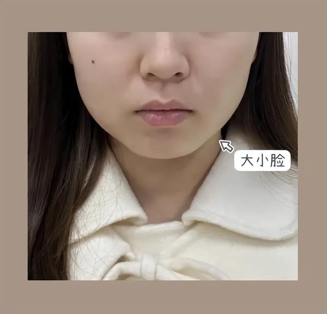 脂肪型发腮了还能变回去吗，20岁发腮了还能变回去吗