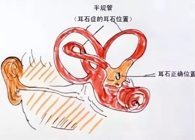 耳石症三种复位手法图片，耳石症简单手法复位图