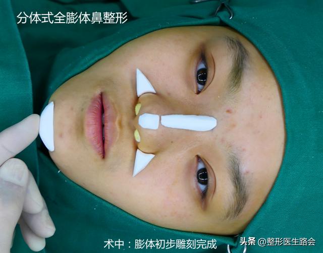 填充法令纹大概多少钱,填充法令纹大概能维持多久