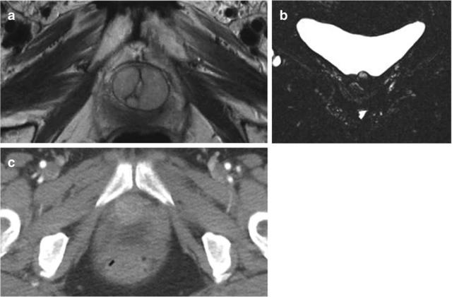 压力性尿失禁_(SUI)__尿道填充剂